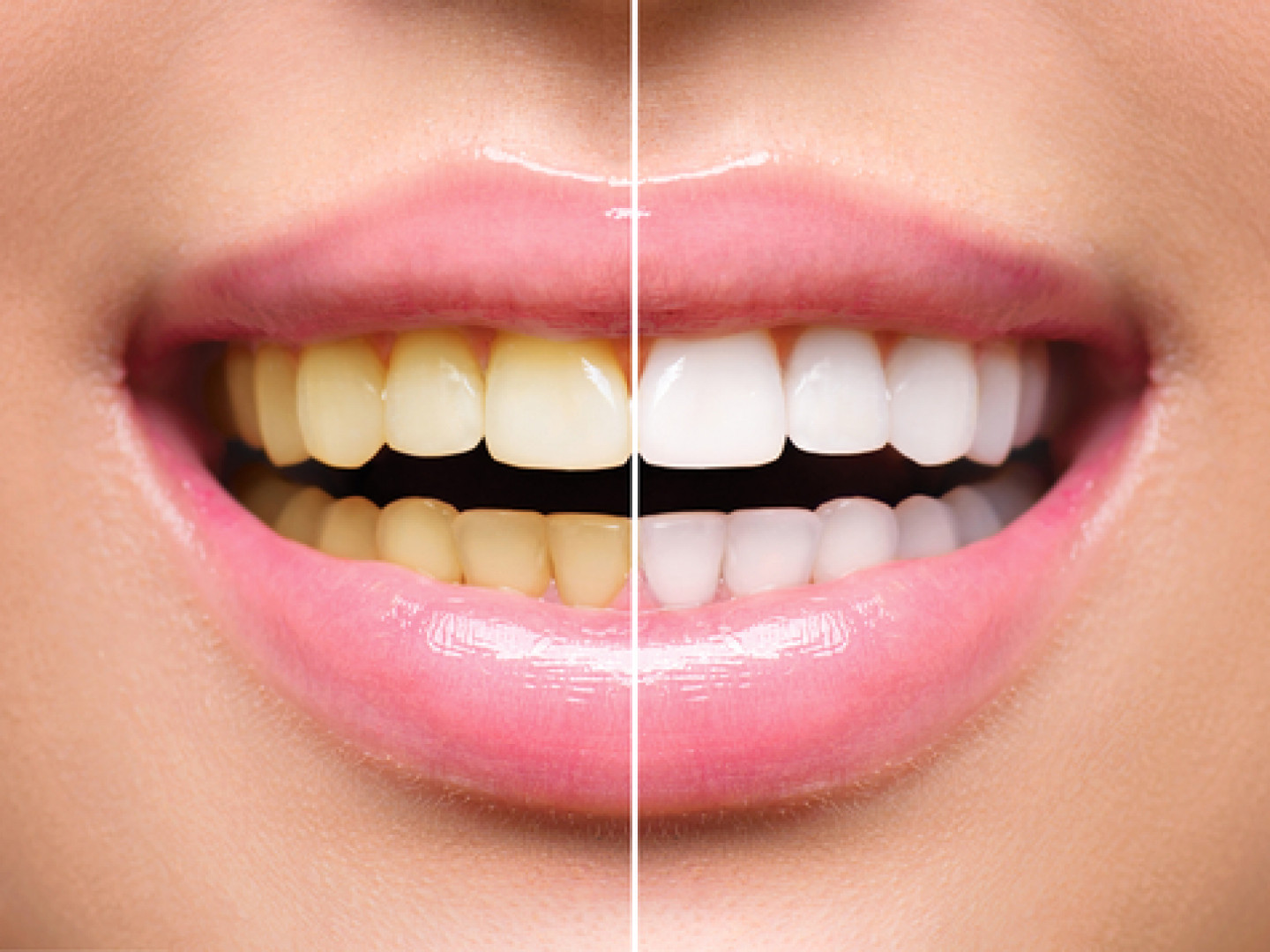 Safe Teeth Whitening General Dentistry Teeth Whitening Grand Junction, CO Barr Family